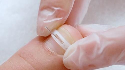 nagelbeugel
